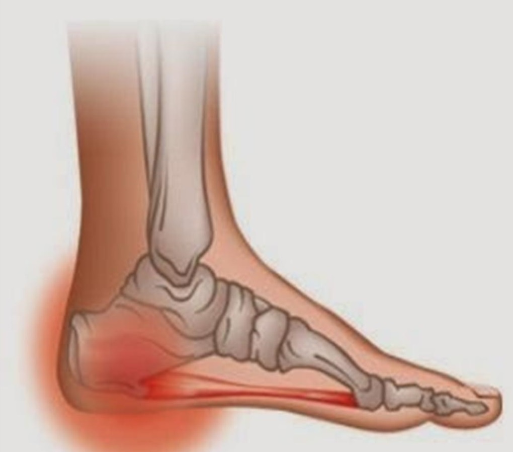 Heel pain and plantar fasciitis treatment oakville physiotherapy