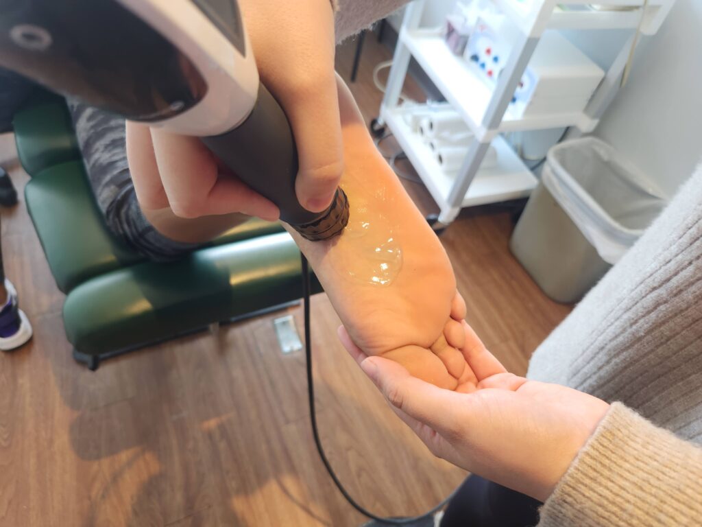 foot being treated by physiotherapist for plantar fasciitis. shockwave treatment on heal.