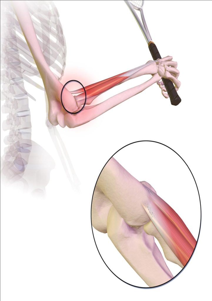 Tennis Elbow Pain and Treatment Physiotherapy Oakville a drawing of the bones of the elbow with pain red area over the outside elbow and forearm
