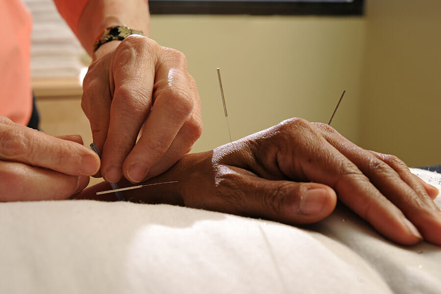 Acupuncture on hand in oakville three needles