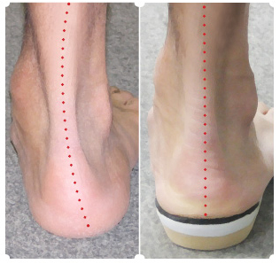 Oakville orhotics for knee pain, picture of a persons foot collapsing without orthotic and then being supported with the custom orthotic