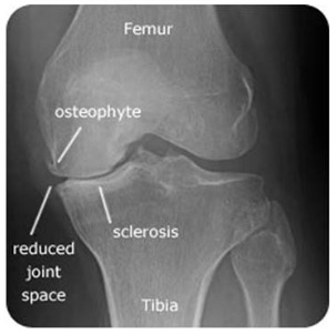 oakville physiotherapy knee osteoarthritis xray