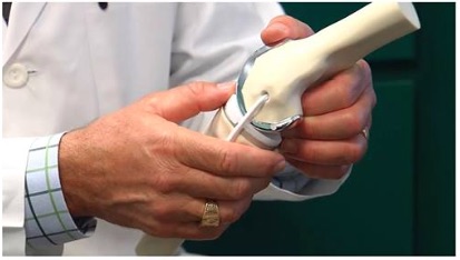 physiotherapy oakville knee replacement model