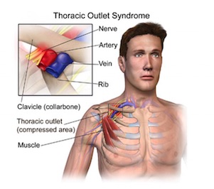 oakville physiotherapy thoracic outlet syndrome anatomy