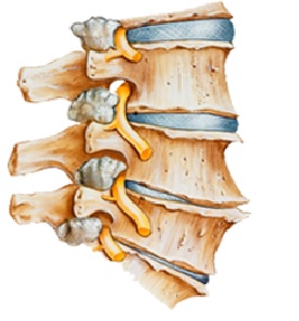 physiotherapy oakville cervical spine degeneration