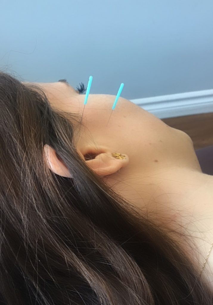 oakville physiotherapy TMJ acupuncture